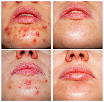 What Causes Adult Acne? 6 Hidden Triggers and How to Clear Your Skin