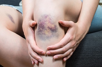 How Long Do Bruises Actually Take to Heal? The Complete Timeline