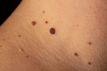 What Are Skin Tags? Causes, When to Worry, and Safe Removal Options